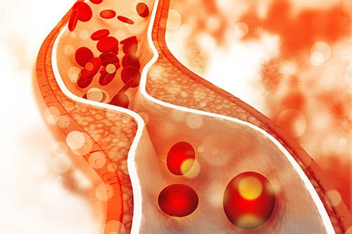 Atherosclerosis