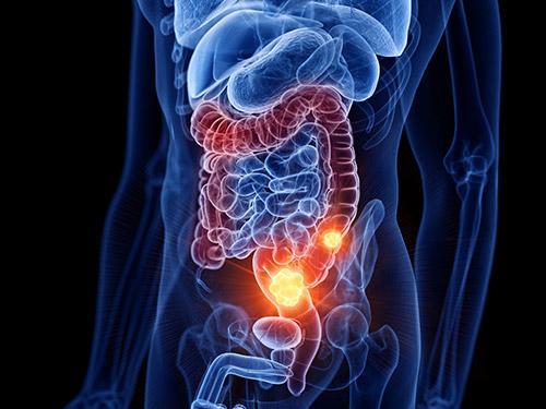 Bowel cancer area diagram