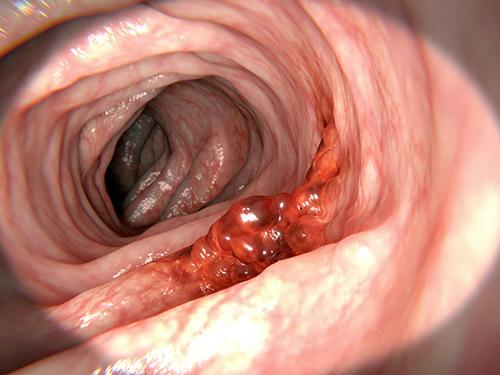 What you need to know about bowel cancer