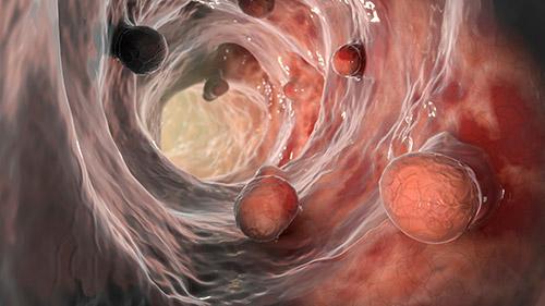 Bowel polyps