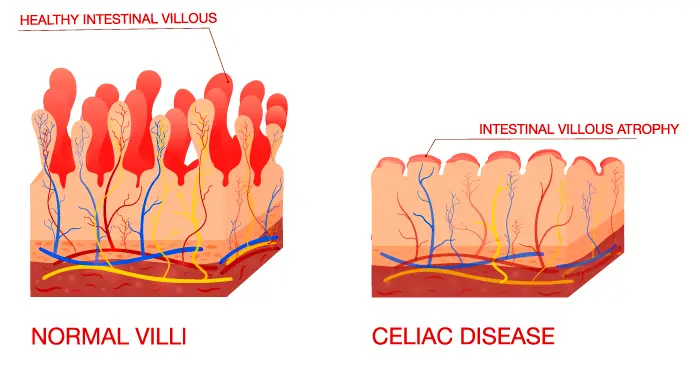 Coeliac disease affects the gut lining