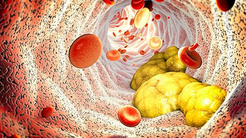 Fatty build up in the arteries