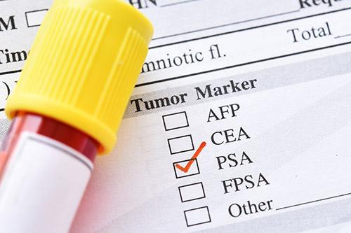 What you need to know about the PSA blood test