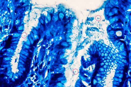 Stomach with H. pylori infection