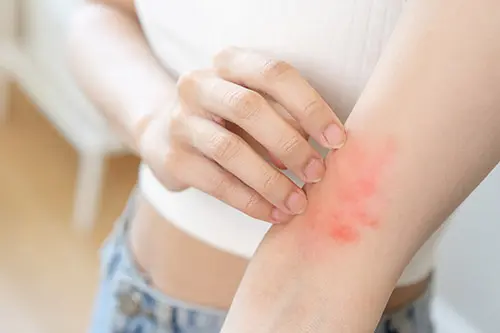 Irritated skin inflammation