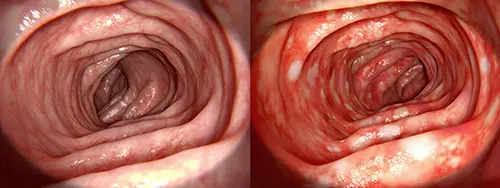Normal and inflamed bowel